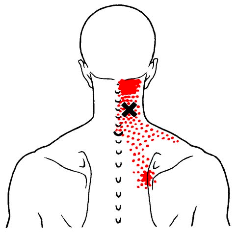 Muscle Knots in Shoulder